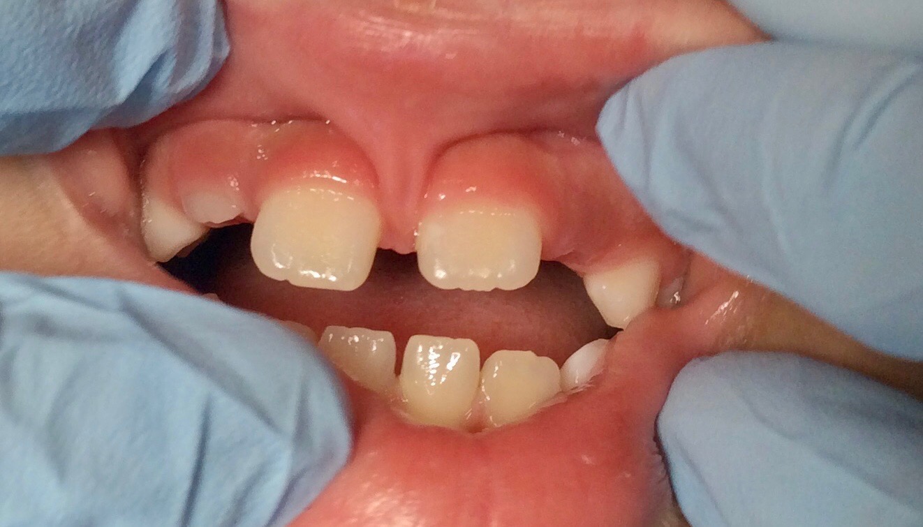 Teeth with lip and frenum (tissue from lip to gums)